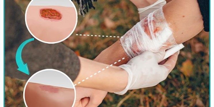 Iranian firm produces, exports advanced wound dressings 1 Iranian firm produces, exports advanced wound dressings