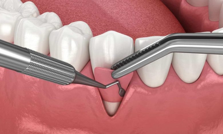 Iranian researchers develop nano-based gelatin sponge to speed dental surgery recovery 1 22 crop